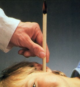 Détails : www.oreillemudry.ch Souvent appelées bougies Hopi, les bougies auriculaires sont connues depuis l’Antiquité. Elles sont utilisées pour nettoyer le cérumen contenu dans les oreilles.